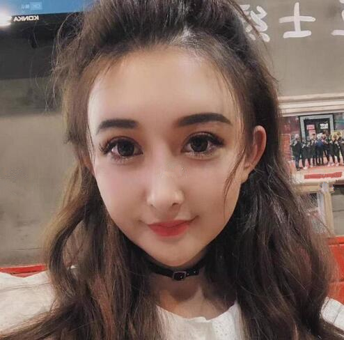 深圳陽光全臉填充后兩個(gè)月效果
