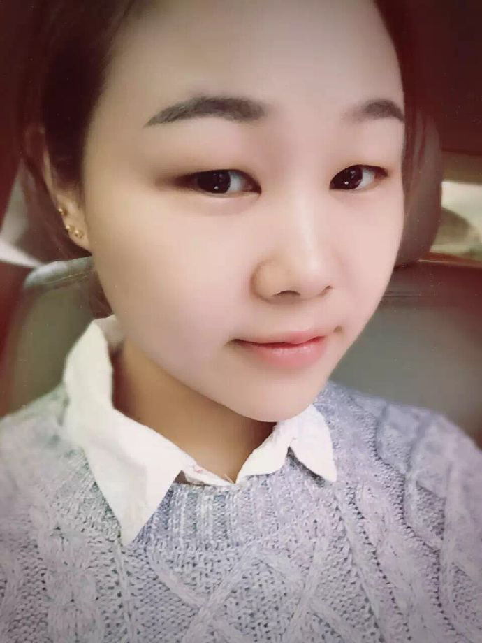 腫眼泡應(yīng)該做哪種雙眼皮？汕頭曙光雙眼皮三個月效果分享