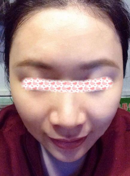 像我一樣寬鼻翼的小姐姐們可以放心找李旭平做隆鼻了，親測好評