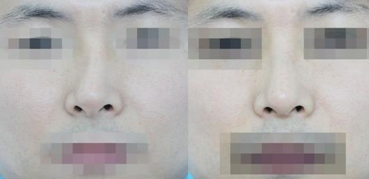 不要被營(yíng)銷號(hào)帶偏了，鼻骨矯正其實(shí)很簡(jiǎn)單