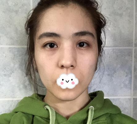 大連沙醫(yī)生整形付德林做的自體軟骨隆鼻效果，給大家做個參考