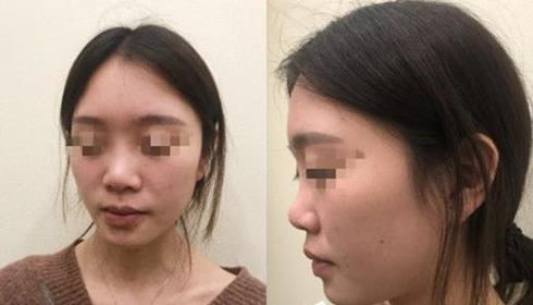耳軟骨隆鼻術(shù)后三個(gè)月，我有了韓佳人同款美鼻