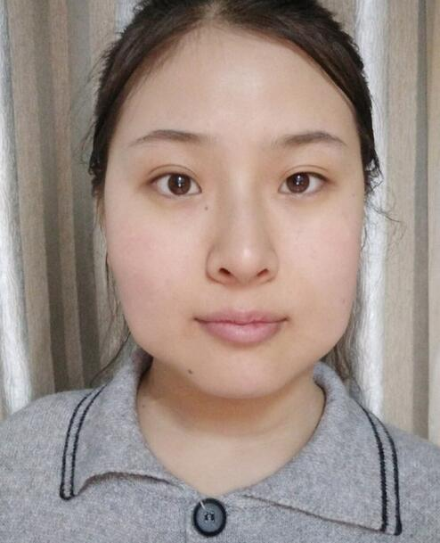 杭州時(shí)光磨骨前后對(duì)比，你整成這樣還缺王思聰嗎