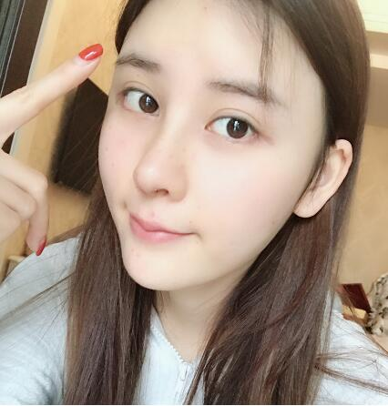 這么好的效果，不來(lái)蘭州美月做膨體隆鼻真是白瞎了醫(yī)生的技術(shù)
