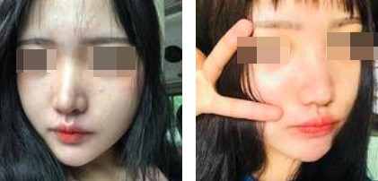 一個(gè)鼻子讓一張臉迅速高級(jí)，還不考慮做個(gè)鼻綜合嗎