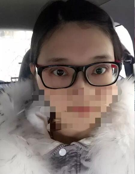 北京京民雙眼皮修復(fù)案例分享，說是媽生眼我都信