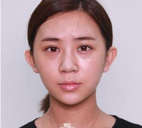 深圳鵬程整形劉冰做的鼻子真絕了，跟我想象的一模一樣
