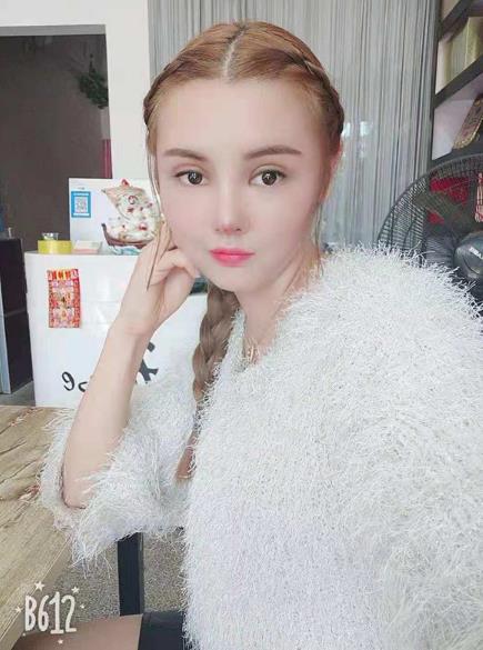 長沙雅美眼鼻整形案例術(shù)后一個月效果
