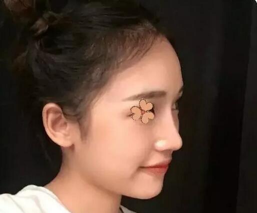 深圳福華整形陳貞宜超體隆鼻術(shù)后一個月