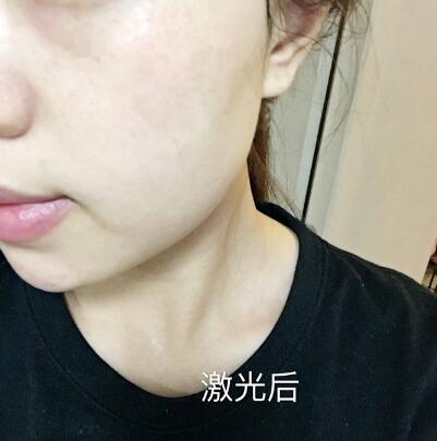 紹興維美整形激光祛斑兩個(gè)療程，皮膚像剝了殼的雞蛋