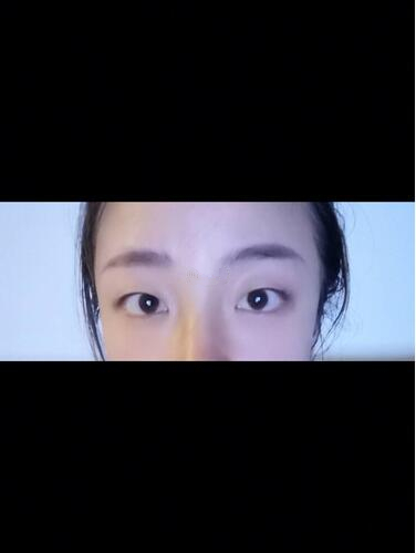 西安時(shí)光整形郭淑華雙眼皮案例分享，一個(gè)月就這么自然