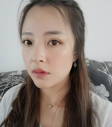 濟(jì)南韓式整形雙眼皮案例分享，單看術(shù)后半個(gè)月效果還以為手術(shù)失敗了