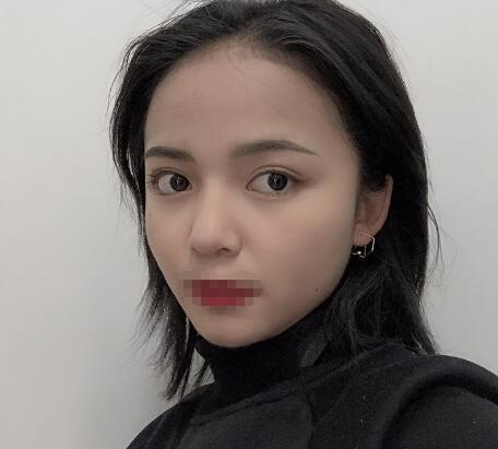 長(zhǎng)沙愛(ài)思特整形定點(diǎn)雙眼皮案例分享，蘿莉到御姐的轉(zhuǎn)變