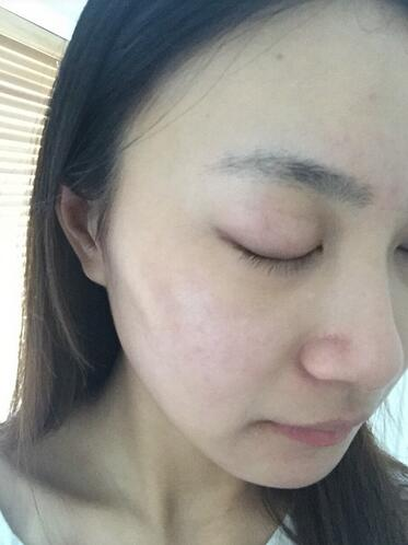 合肥艾雅整形紅藍(lán)光祛痘兩個療程效果，痘痘都消失了