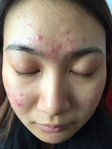 合肥艾雅整形紅藍(lán)光祛痘兩個療程效果，痘痘都消失了