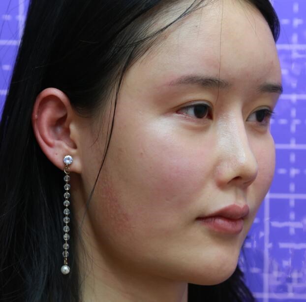長(zhǎng)沙亞韓整形陳明松下頜角整形前