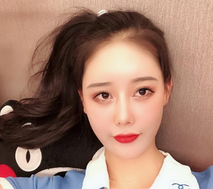 長(zhǎng)沙亞韓整形陳明松下頜角整形一個(gè)月效果