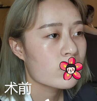 北京基礎(chǔ)美下頜角整形案例效果分享，黃大勇果然名不虛傳