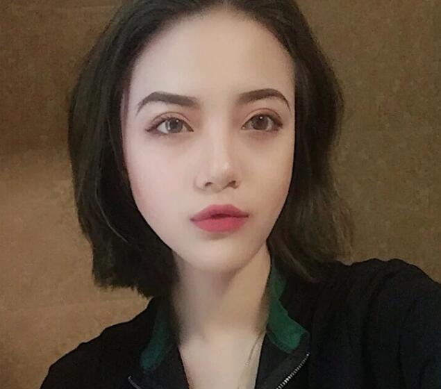 重慶華美下頜角整形術后一個月效果