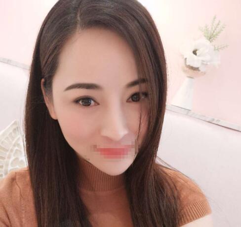 赤峰現(xiàn)代婦產(chǎn)醫(yī)院醫(yī)療美容科袁俊龍雙眼皮修復(fù)術(shù)后一個(gè)月