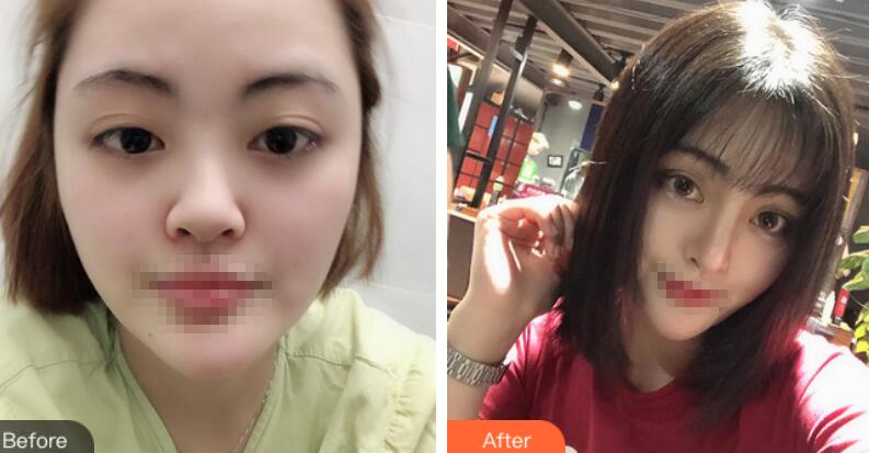 上海賽美瑞整形張化舉鼻綜合術(shù)后兩個月效果分享