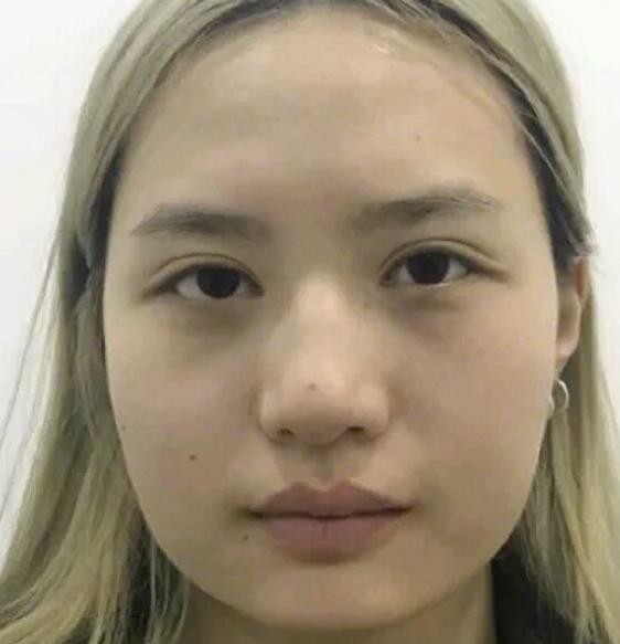 廣州中科美整形陳昌華雙下巴吸脂術前效果