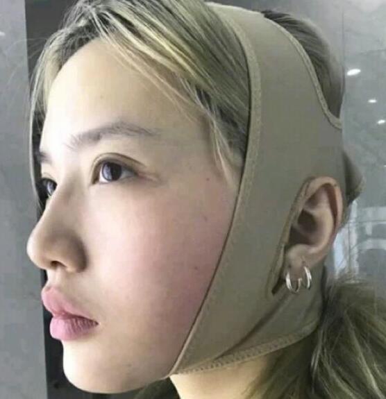 廣州中科美整形陳昌華雙下巴吸脂術后一周效果