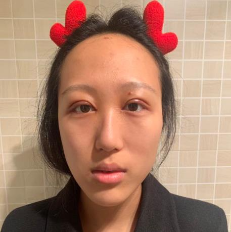 上海華美醫(yī)療美容醫(yī)院楊亞益做眼部修復整形怎么樣？