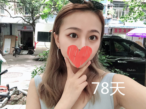 杭州靜港林忠泵埋線雙眼皮案例1-7天效果圖分享，讓你的眼睛魅力四射