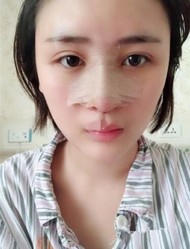 濟(jì)南鵬愛整形醫(yī)院怎么樣？濟(jì)南鵬愛王飏隆鼻案例分享