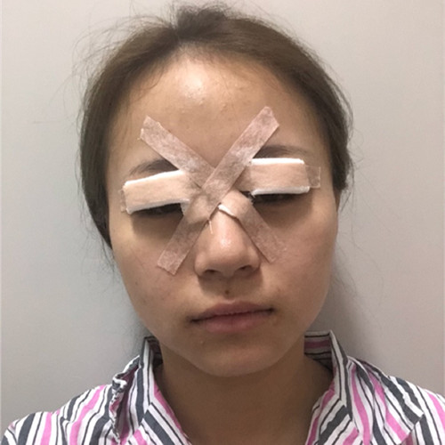 杭州靜港林忠泵埋線雙眼皮案例1-7天效果圖分享，讓你的眼睛魅力四射