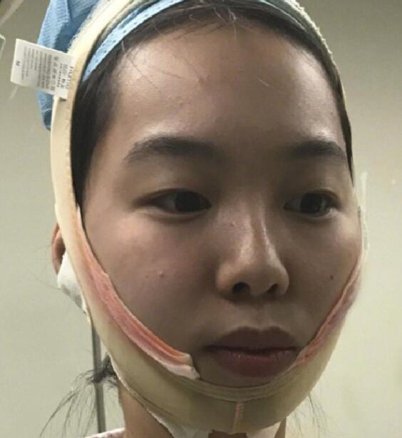 下頜角截骨手術中