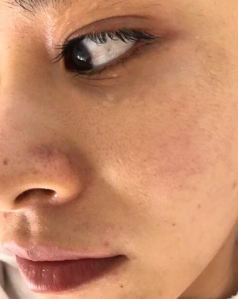 福州愛思特比華利整形林秋蓉醫(yī)生做光子嫩膚過程體驗(yàn)！皮膚Q彈