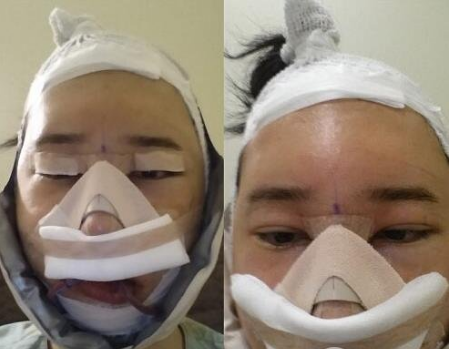 重慶三峽中心醫(yī)院頜面外科張宇下頜角案例手術效果對比圖
