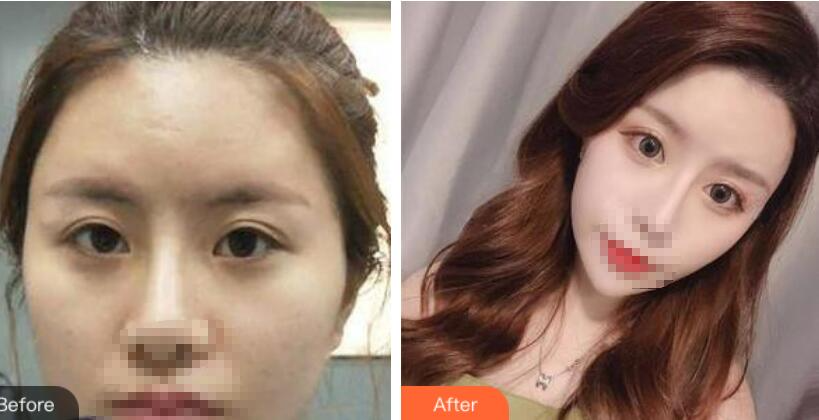 鄭州風信子整形美容醫(yī)院雙眼皮案例效果對比圖分享