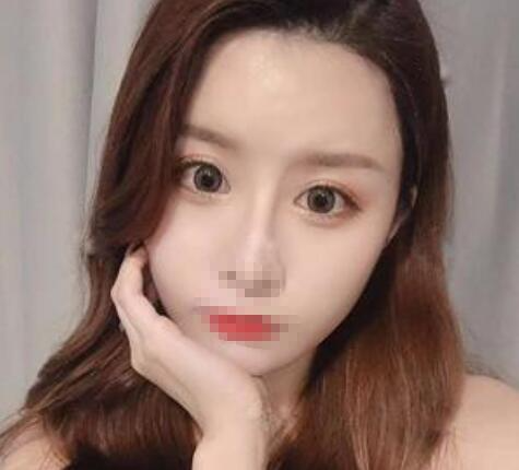 鄭州風信子整形美容醫(yī)院雙眼皮案例效果對比圖分享