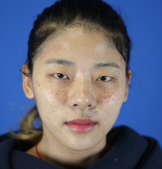 福州愛思特比華利整形林秋榮激光祛斑效果太贊了，終于沒人叫我“斑花”了