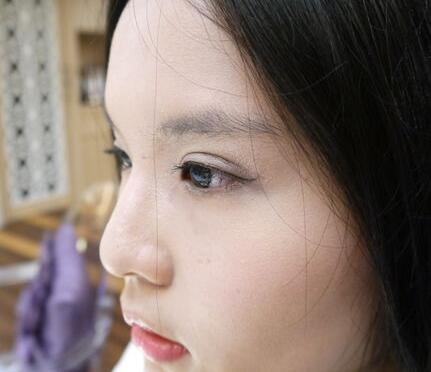 青島大學醫(yī)學院整形美容科陳振宇醫(yī)生做雙眼皮怎么樣？案例效果太驚艷