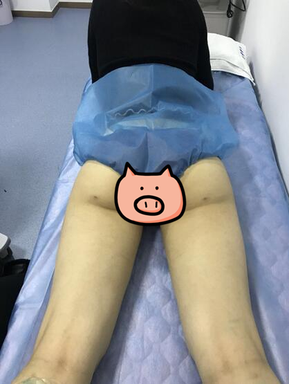 鄭州至美整形專家劉永生做大腿吸脂怎么樣？劉永生做大腿吸脂案例效果