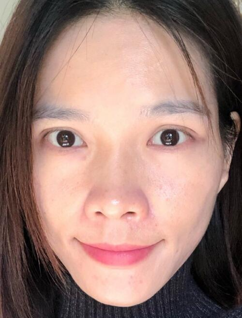北京藝星整形專家廖苑利做光子嫩膚怎么樣？廖苑利光子嫩膚案例效果展示