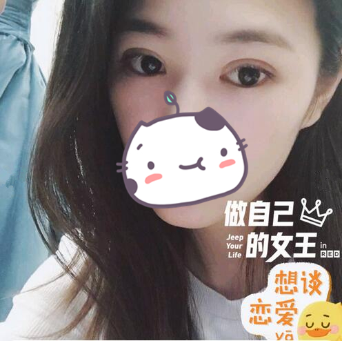 做完雙眼皮手術恢復后的樣子
