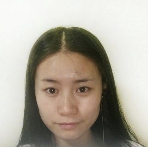 長(zhǎng)春銘妍醫(yī)療美容門診部雙眼皮整形案例。