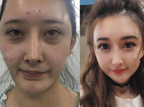 面部脂肪填充，整個(gè)人都發(fā)生了很大變化。