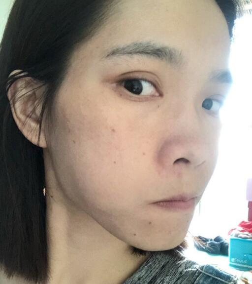 北京藝星整形專家廖苑利做光子嫩膚怎么樣？廖苑利光子嫩膚案例效果展示