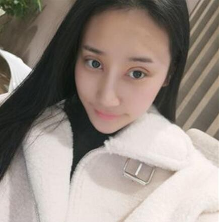 北京葉子整形美容醫(yī)院做焊接雙眼皮效果怎么樣？北京葉子整形焊接雙眼皮案例展示