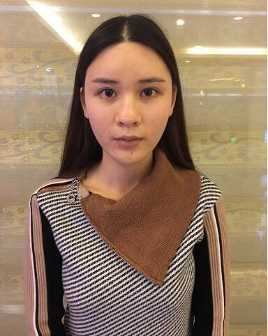 西安艾薇美整形專家黃志祥做肋軟骨隆鼻怎么樣？黃志祥肋軟骨隆鼻案例