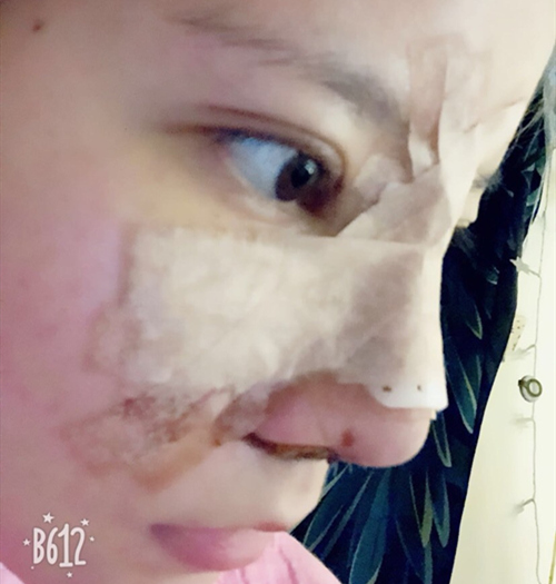 嘉興曙光美容醫(yī)院整形專家王良發(fā)做假體隆鼻怎么樣？王良發(fā)假體隆鼻案例