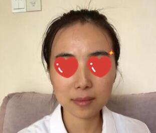 上海美萊醫(yī)生熊師做玻尿酸隆下巴怎么樣，熊師玻尿酸隆下巴案例分享