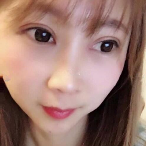 淄博美聯(lián)臣醫(yī)療美容醫(yī)院做切開雙眼皮怎么樣？切開雙眼皮案例分享