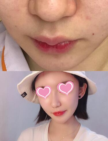 北京當代醫(yī)院整形專家胡忠明做鼻翼縮小怎么樣？胡忠明鼻翼縮小案例分享